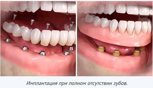 Что нужно знать об имплантах зубов Что нужно знать об имплантах зубов