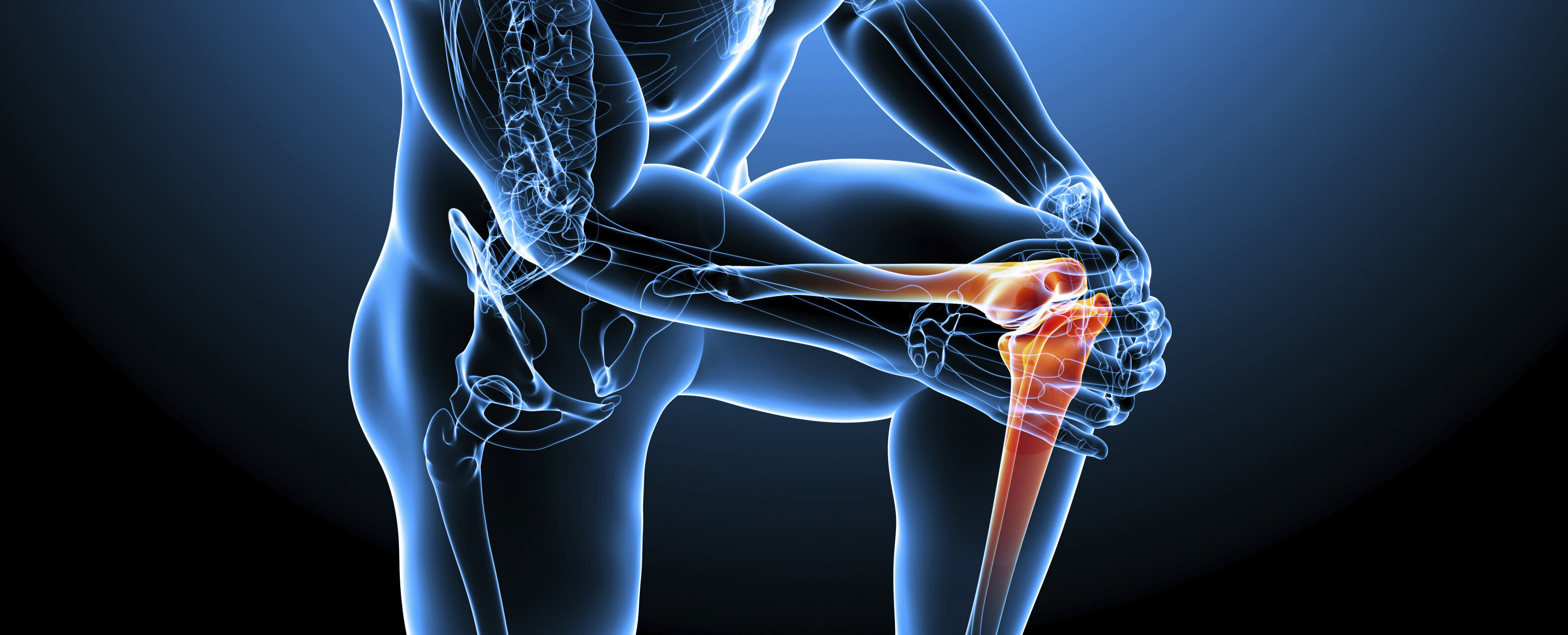 Прочность сустава. Кальций здоровые кости. Синовит тазобедренного сустава мрт. Остеопороз коленного сустава на мрт. Osteoporosis bones.