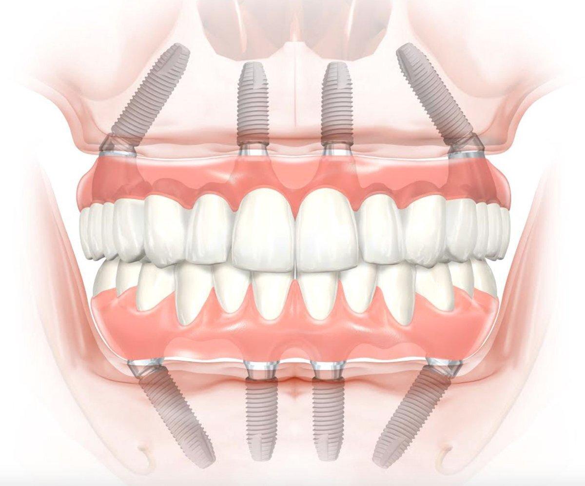 верхняя зубная челюсть фото