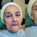 Что такое лоботомия фото до и после пациентов это