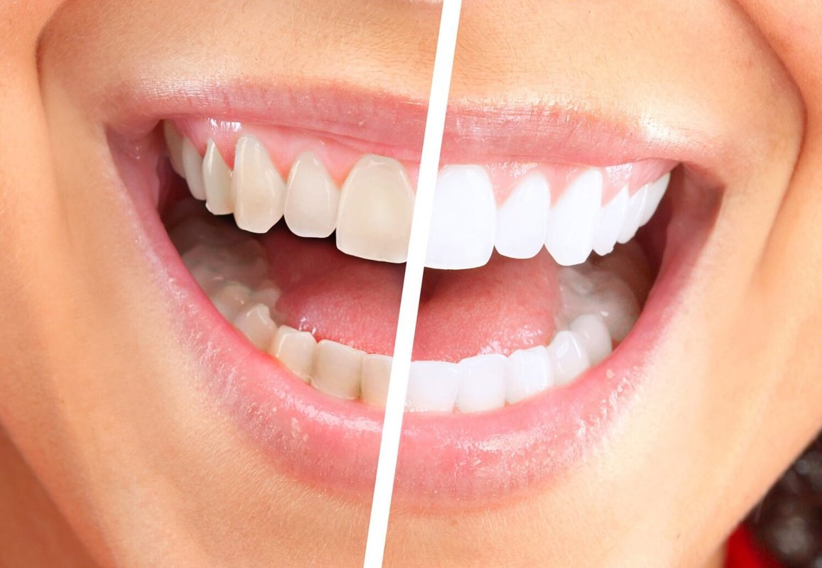 Отбеливание зубов Teeth Whitening