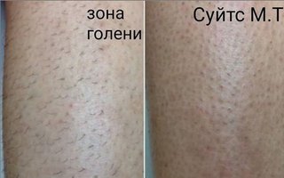 фотография работы врача Марины Томовны Суйтс