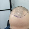 фото от пользователя Иван Бородин в отзыве о клинике пересадки волос FUE Clinic