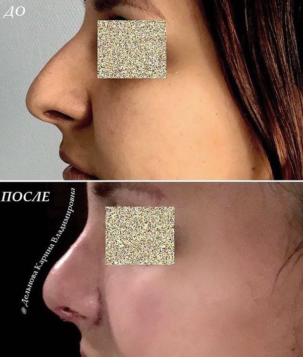 Как лечат непроходимость кишечника