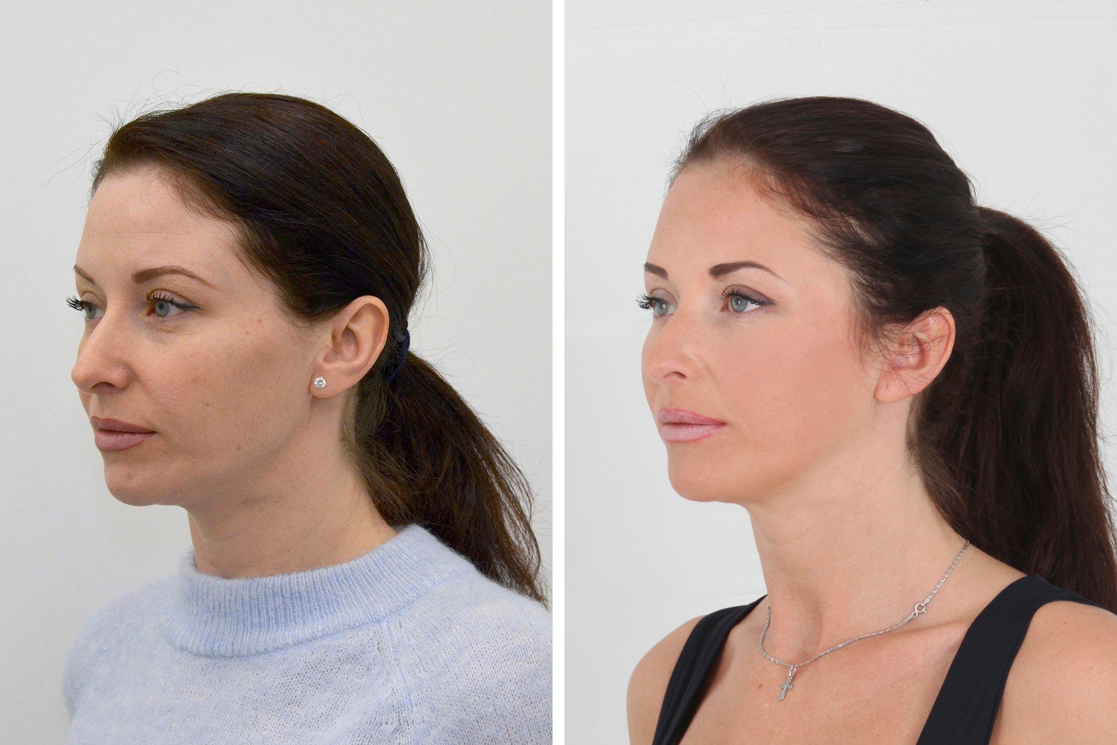 Ботокс нижней трети лица фото до и после