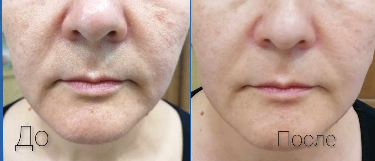 бонарт черкесск