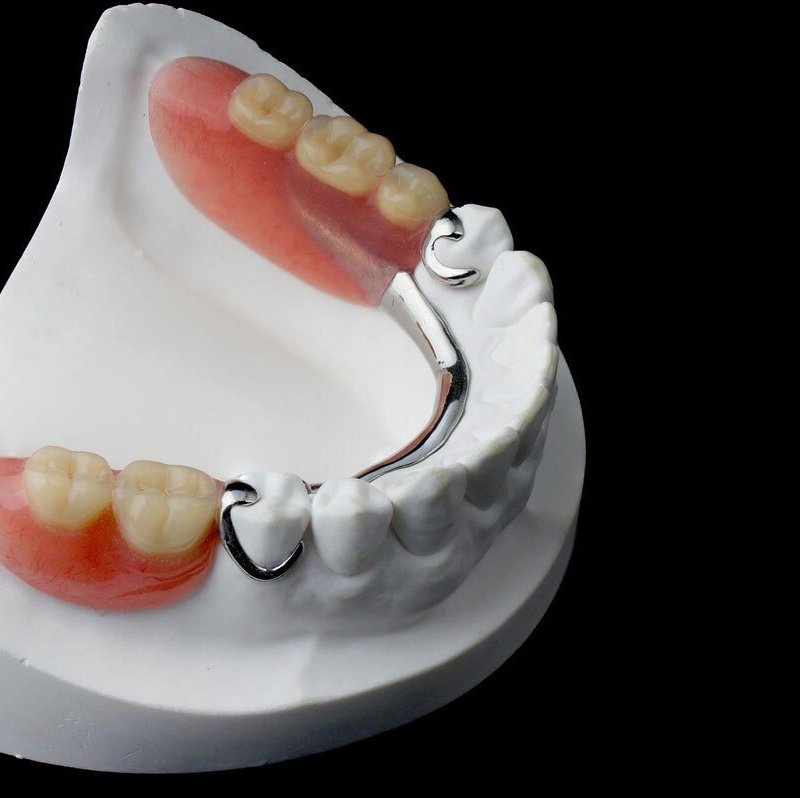 Бюгельный протез на жевательные зубы как выглядит ProfDental, стоматология на улице Мира в Мытищах, Москва - отзывы, фото, цены, т