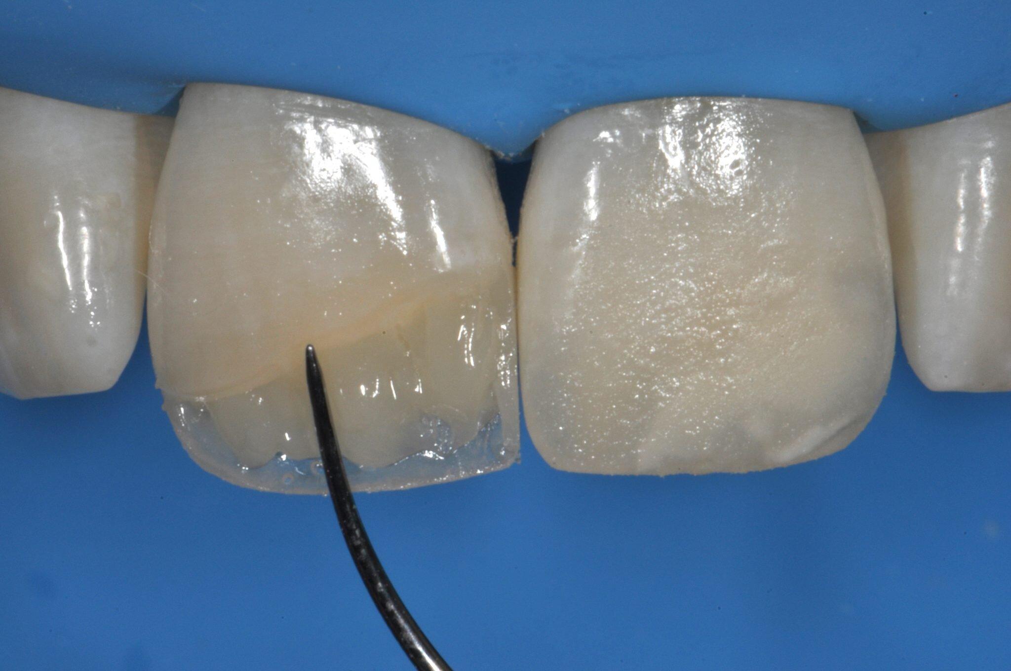 Зубная реставрация. Композитные виниры кариес. Композитная коронка на зуб. Восстановление фронтальных зубов.