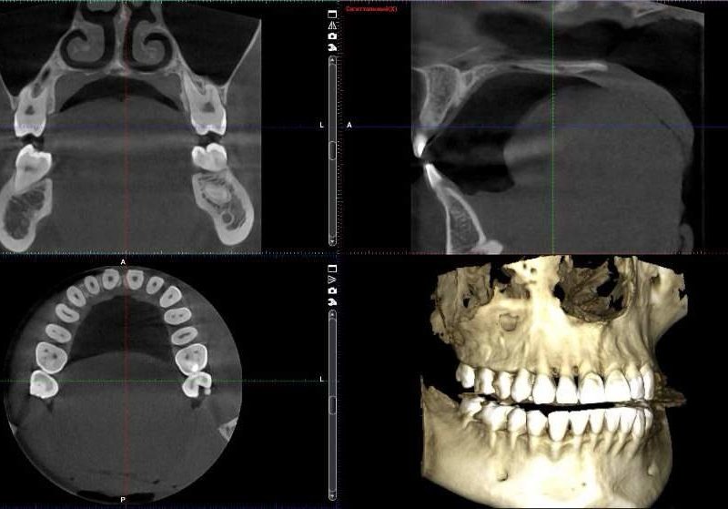 Кт верхней и нижней челюсти фото