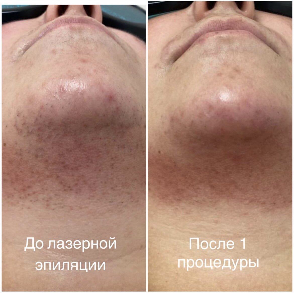 Лазерная эпиляция верхней губы отзывы