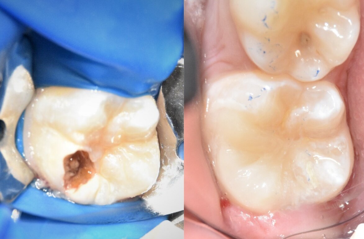 фотография работы Центра цифровой стоматологии Dr.Edil Boribay на улице Розыбакиева