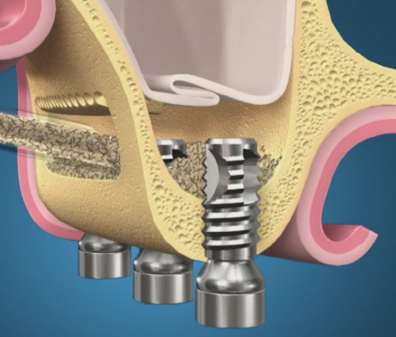 Синус лифтинг. Гидравлический синус лифтинг. Имплантация без синус лифтинга.