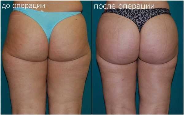 Липосакция бедер до и после отзывы Клиника пластической хирургии и оториноларингологии на улице Тимирязева в Минске